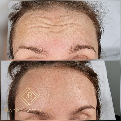 ANTI-WRINKLE INJECTIONS Botox Mansfield Bonita Aesthetics