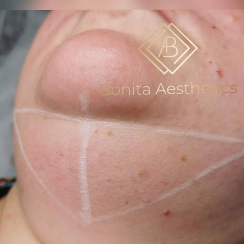 FAT DISSOLVING INJECTIONS Mansfield Bonita Aesthetics