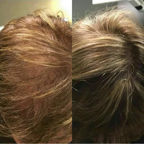 HAIR LOSS MESOTHERAPY (dr Cyj) Mansfield Bonita Aesthetics