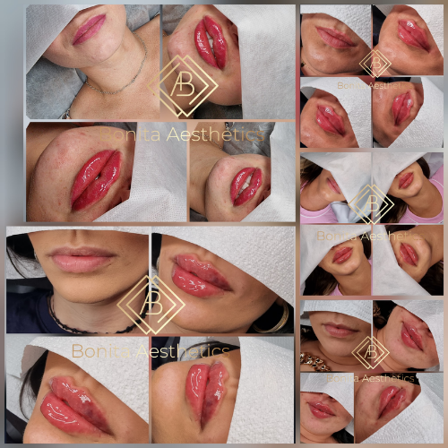 LIP FILLER (Russian Lips) Mansfield Bonita Aesthetics