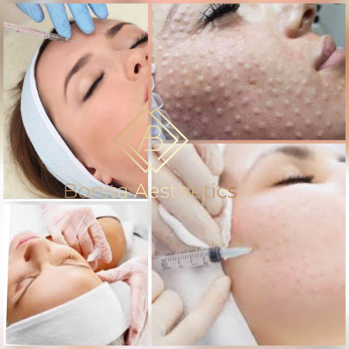 MESOTHERAPY Mansfield Bonita Aesthetics