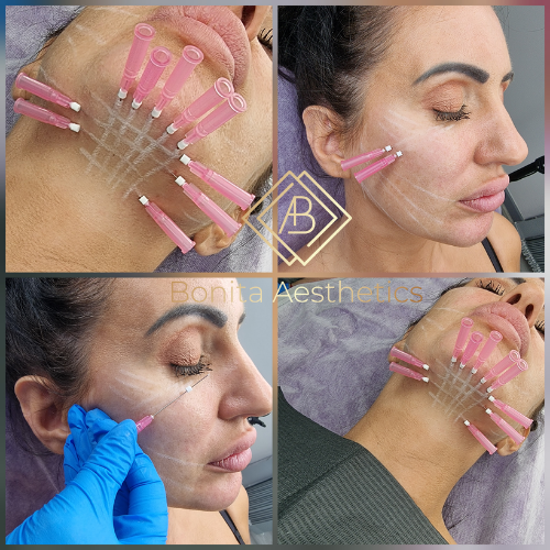 PDO Thread Lift Mansfield Bonita Aesthetics