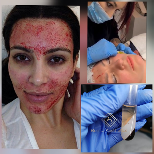 Platelet Rich Plasma (VAMPIRE FACELIFT) Mansfield Bonita Aesthetics